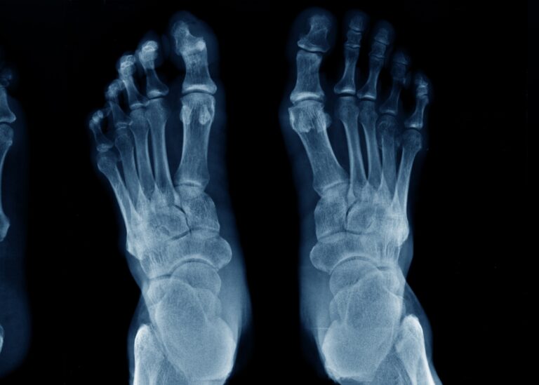 Read more about the article Quando è necessaria una radiografia dopo una distorsione alla caviglia?