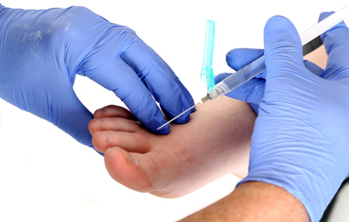 cortisone neuroma morton