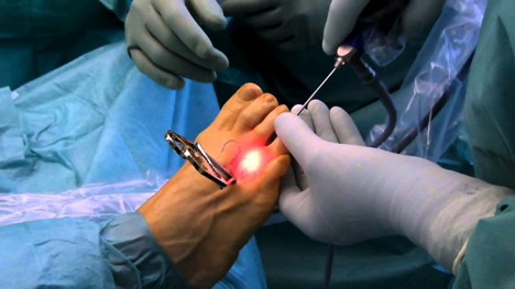 intervento neuroma morton frosinone