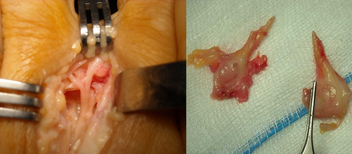 intervento neuroma morton frosinone