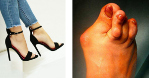 neuroma morton cause