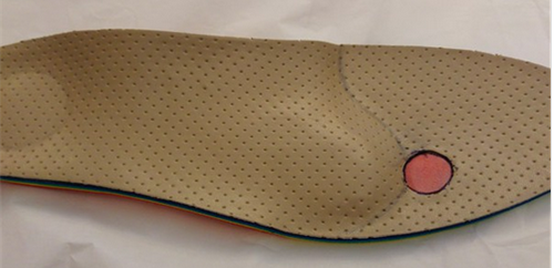 plantare neuroma morton